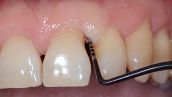 Des dents soignés par un parodontologue
